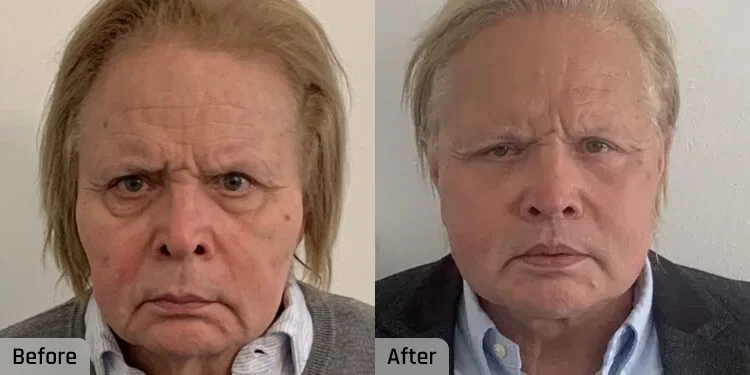 Facelift Before and After