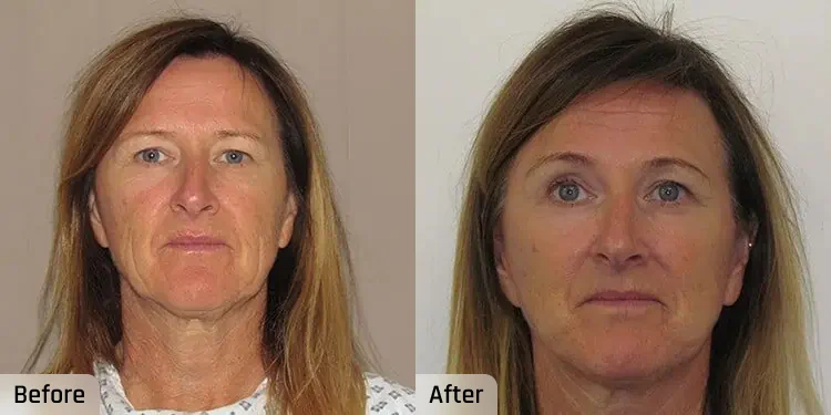 Facelift Before and After