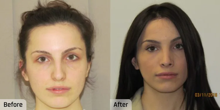 Facelift Before and After