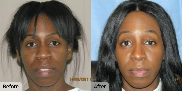 Facelift Before and After