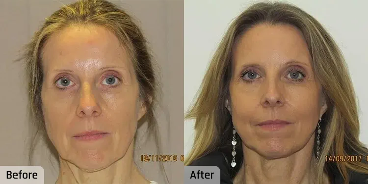 Facelift Before and After