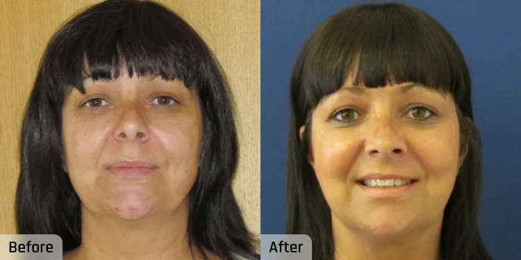 Facelift Before and After