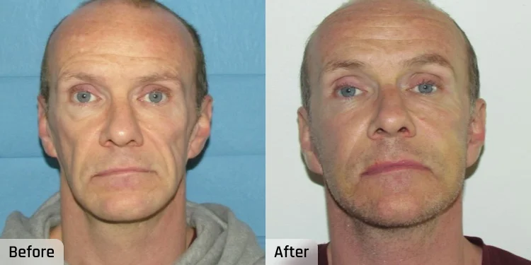 Facelift Before and After