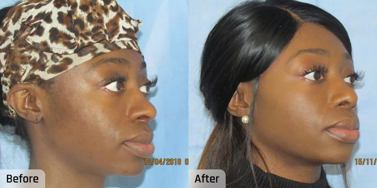 Facelift Before and After