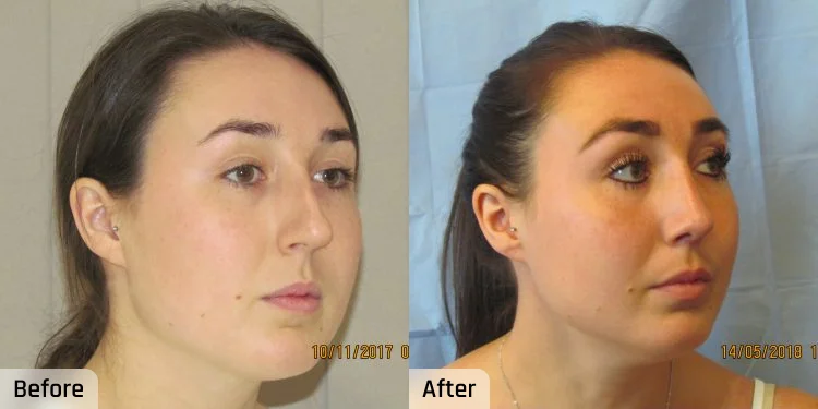 Facelift Before and After