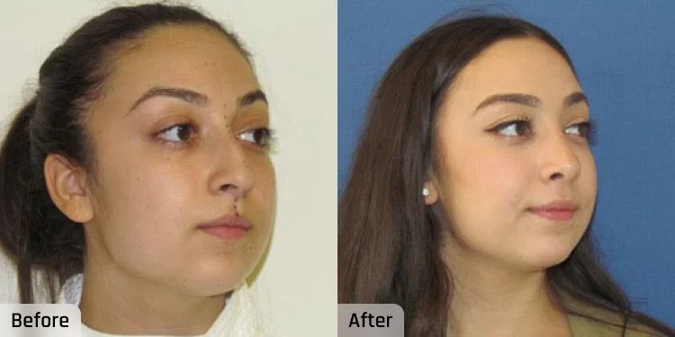 Facelift Before and After