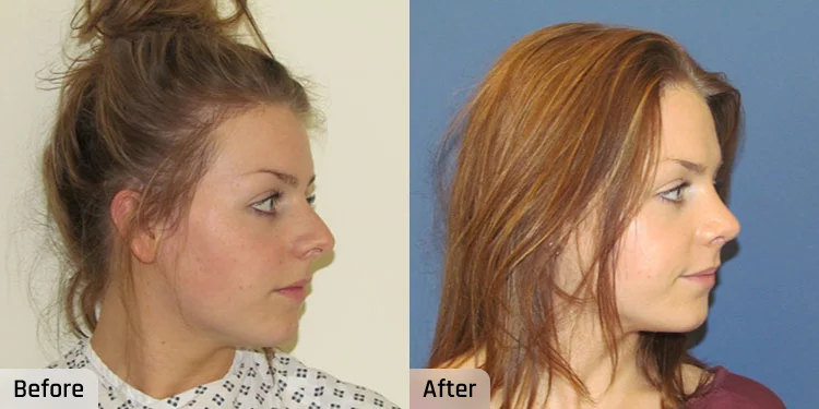 Facelift Before and After