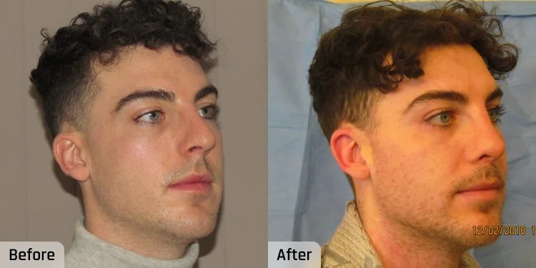 Facelift Before and After