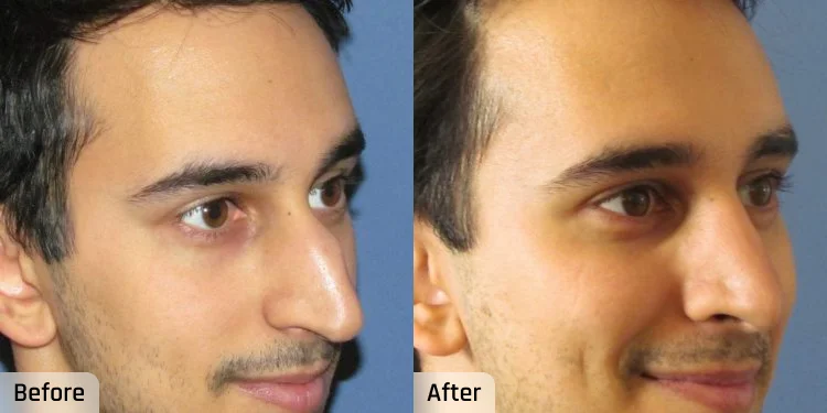 Facelift Before and After