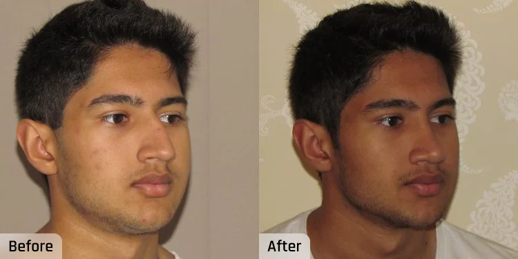 Facelift Before and After